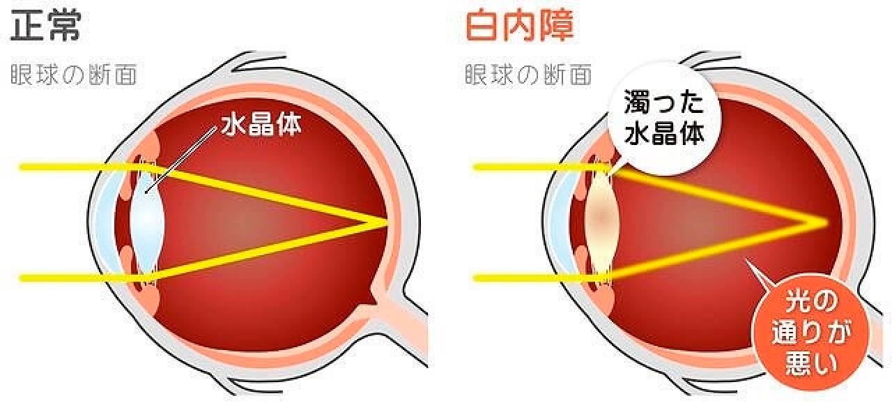 白内障になる原因は？