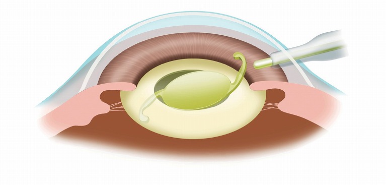 眼内レンズ挿入
