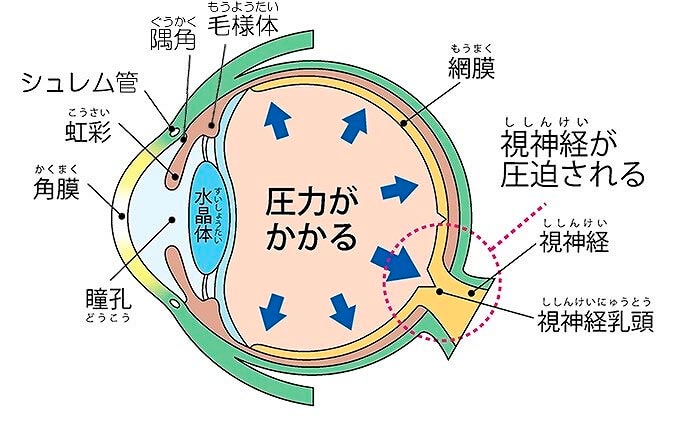 緑内障になる原因は？