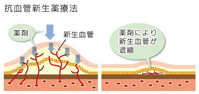 薬物療法(硝子体注射)