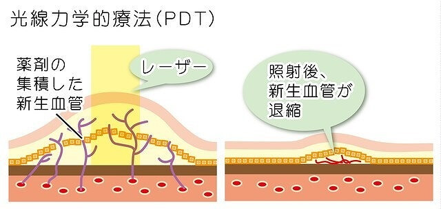 光線力学的療法